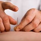 Dry Needling